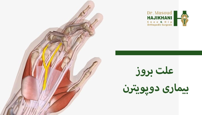 علت بروز بیماری دوپویترن