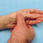 De Quervain's Tendinosis