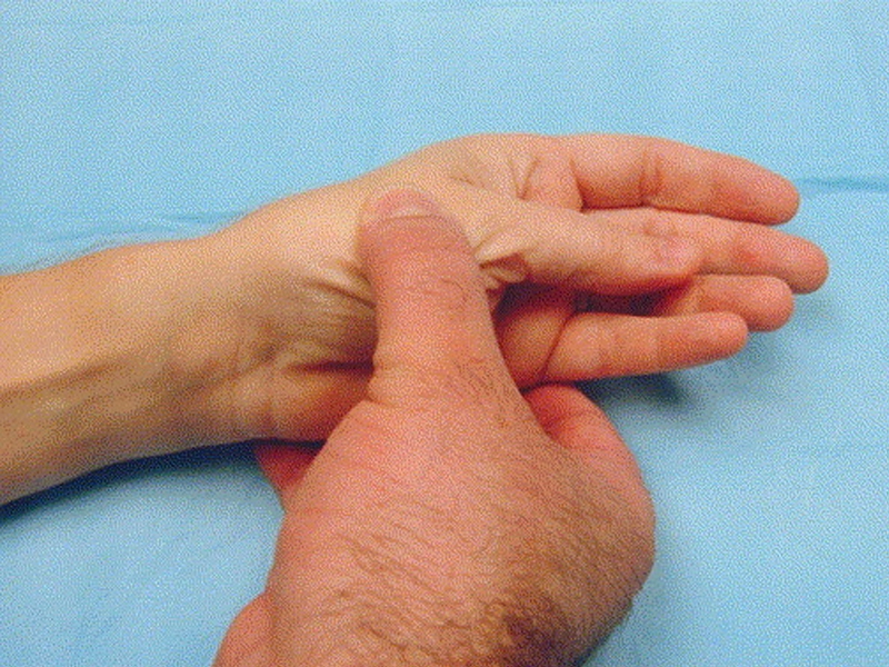 De Quervain's Tendinosis