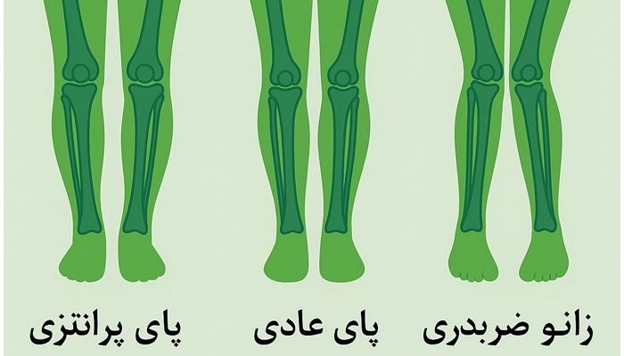  استئوتومی زانو