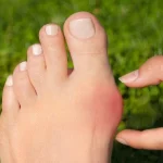 هزینه جراحی هالوکس والگوس