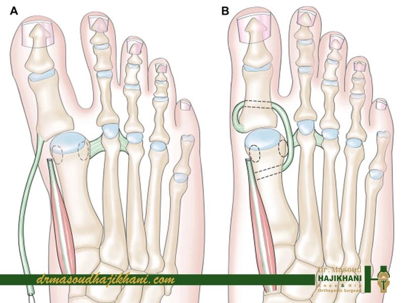 هزینه نهایی جراحی هالوکس والگوس