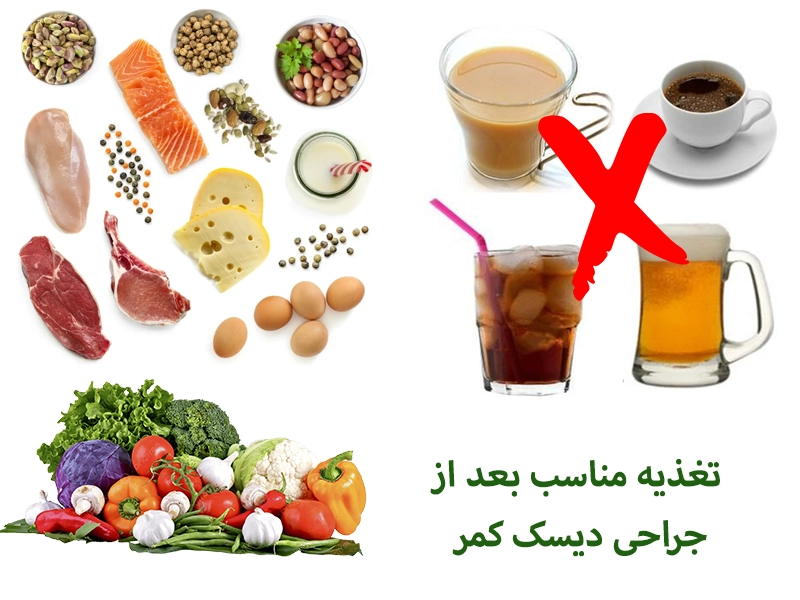 تغذیه مناسب بعد از جراحی دیسک کمر