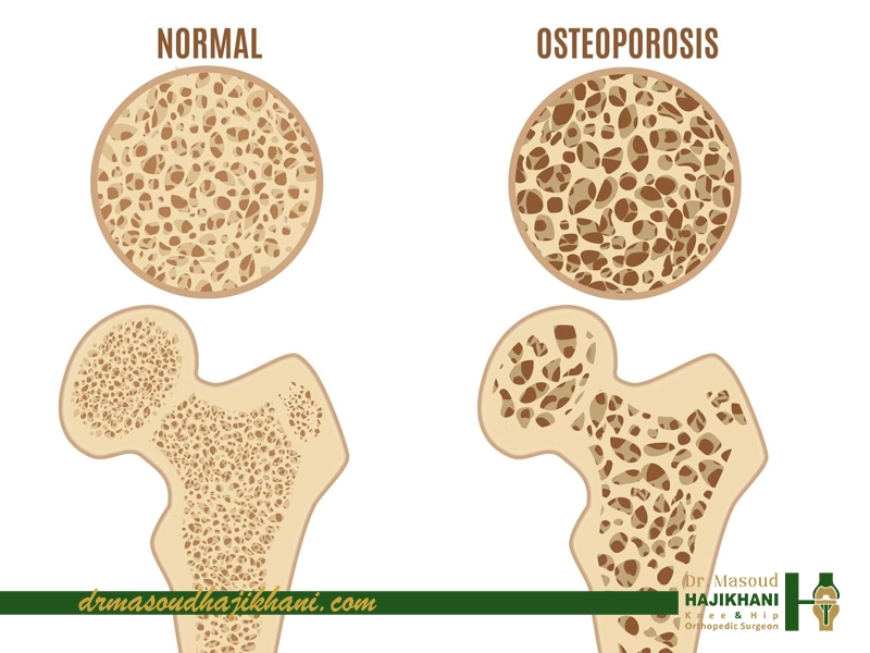 درمان پوکی استخوان