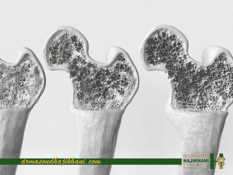 پوکی استخوان